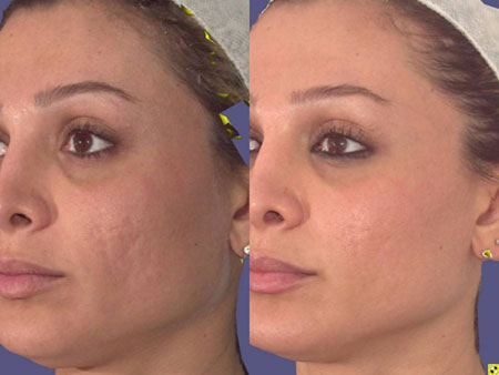 Pixel ® (Fractional Laser Skin Resurfacing) Information