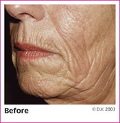 Before Treatment with Sculptra