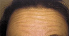 Forehead before Botox Injections