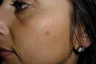  pigmented spot on cheek