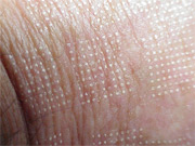 Pixel ® (Fractional Laser Skin Resurfacing) Information