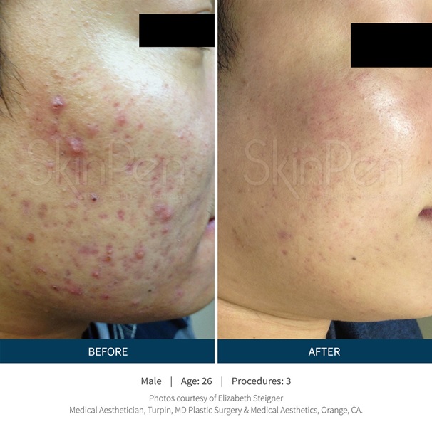 Before and After SkinPen treatment for acne
