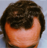 Male front of hair after laser hair loss therapy