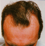 Male front of hair before treatment