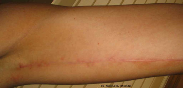 Upper Arm Lift Scars 6 Week Post Surgery