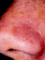 After Comedone Removal With Microdermabrasion