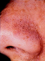 Before Comedone Removal With Microdermabrasion