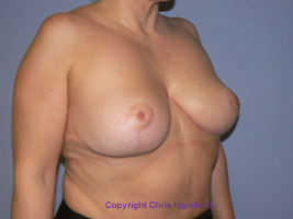 Post Breast Reduction Surgery