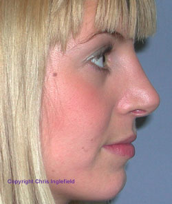 Post Rhinoplasty (Nose) Surgery