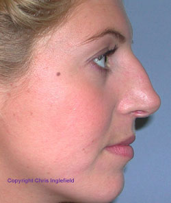 Pre Rhinoplasty (Nose) Surgery