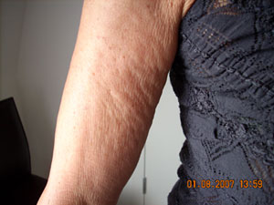 Arm Before Carboxytherapy