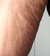 Arm Close-up Before Carboxytherapy