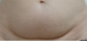 Stomach Before Carboxytherapy