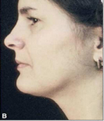 Chin After Laser Lipolysis Treatment