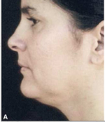 Double Chin Before Laser Lipolysis Treatment