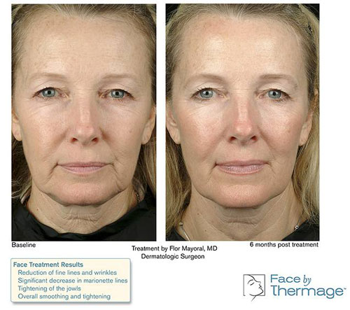 Radiofrequency For Facial Rejuvenation Information