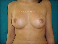 breast augmentation with fat transfer - front view