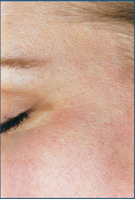 Fine Lines Around the Eyes After Microdermabrasion