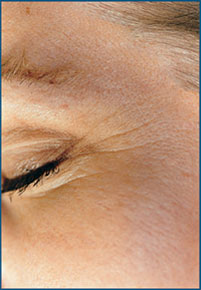 Fine Lines Around the Eyes Before Microdermabrasion
