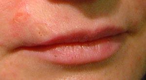Intradermal Nevi on the Lip - After Radiosurgery
