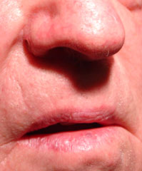 Intradermal Nevus of the Nose - After Radiosurgery