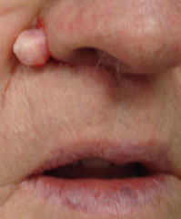 Intradermal Nevus of the Nose - Before