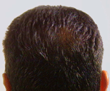 Male back of hair after laser hair loss therapy
