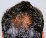 Male back of hair before treatment
