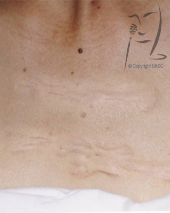 Visible difference in keloid scar after skin camouflage