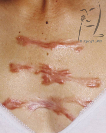 Keloid Scar on female chest