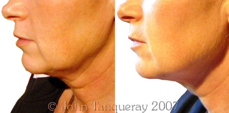Laser Lipolysis Treatment on the Neck and Jawline