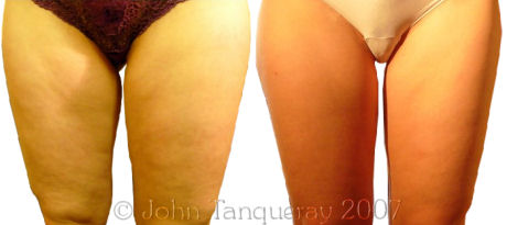 Laser Lipolysis Treatment on the inner and outer thighs