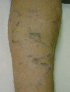 Laser Tattoo Removal - After 15 treatment sessions