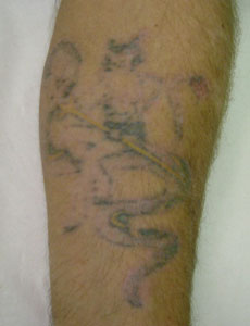 Laser Tattoo Removal - After 7 treatment sessions