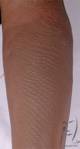 Mesh graft scarring following application of skin camouflage
