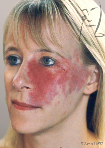 Port Wine Stain on female face