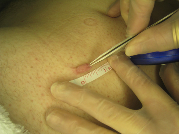 Skin Tag Treatment Using Electrolysis - Step 1