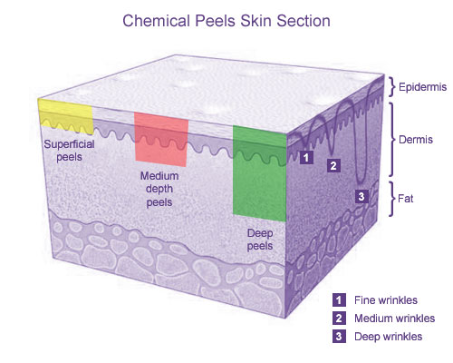 Chemical Peels Skin Section