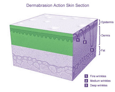 Dermabrasion Action: Skin Section