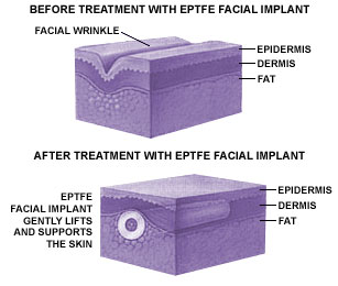 EPTFE Facial Implant