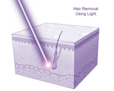 Hair Removal Using Light