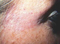 Patient 2 years after 1 laser and 3 IPL treatments.