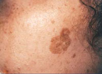 Female with pigmented lesion on the cheek