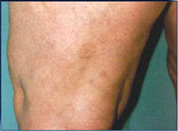 Patient 3 months after 2 laser and 3 IPL treatments.