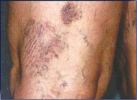 Female with varicose and spider veins.