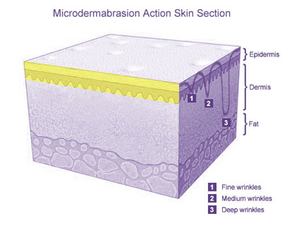 Microdermabrasion Action Skin Section
