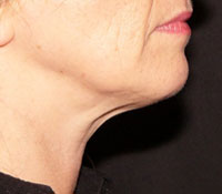 Chin after Thermage treatment