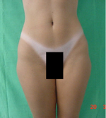 Outer Thighs After Laser Lipolysis Treatment