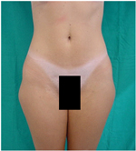 Outer Thighs Before Laser Lipolysis Treatment