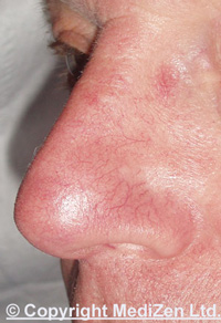 Improvement in thread veins on nose after two Nd:YAG treatments